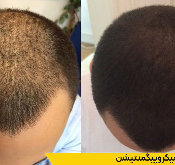 دوره میکروپیگمنتیشن