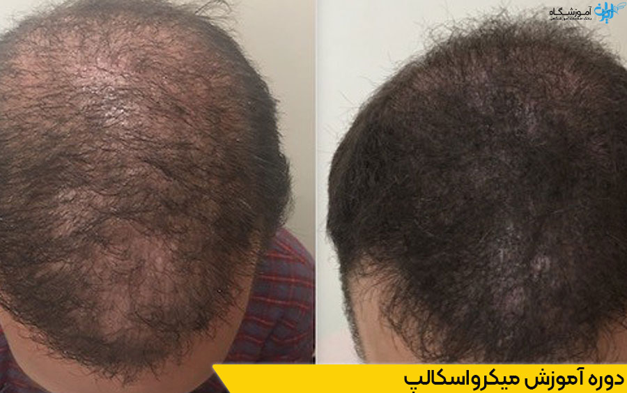 دوره آموزش میکرواسکالپ