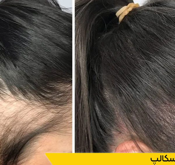 دوره میکرواسکالپ