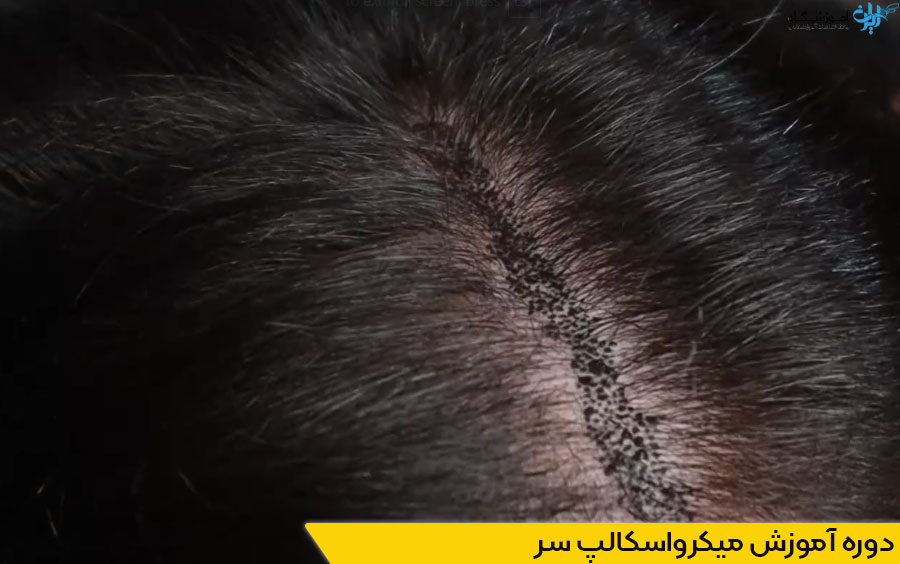 دوره آموزش میکرواسکالپ سر