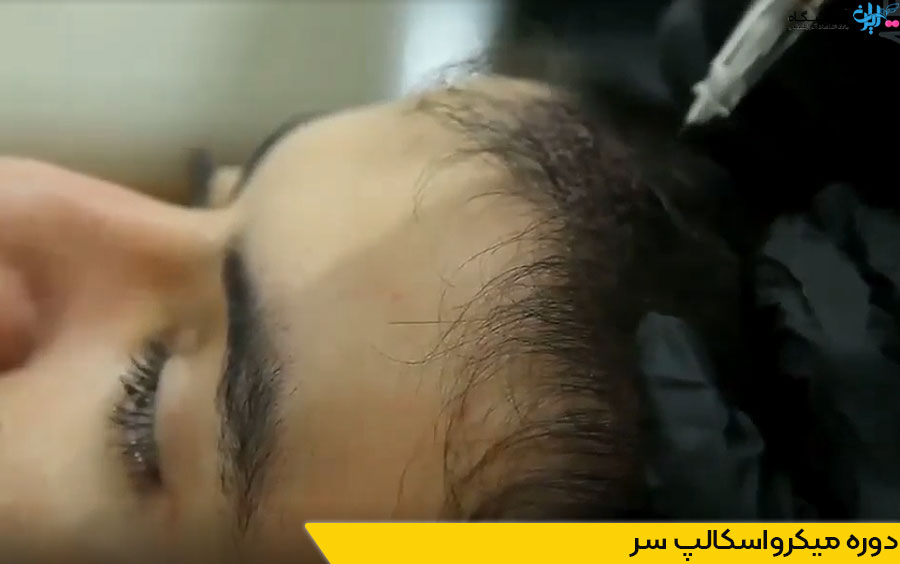 دوره میکرواسکالپ سر