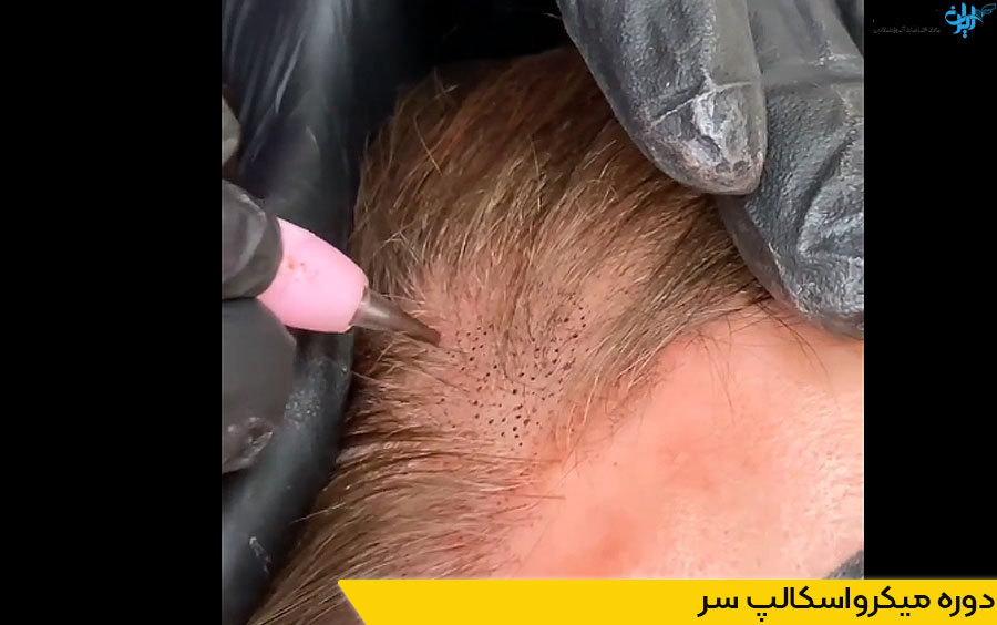 دوره میکرواسکالپ سر