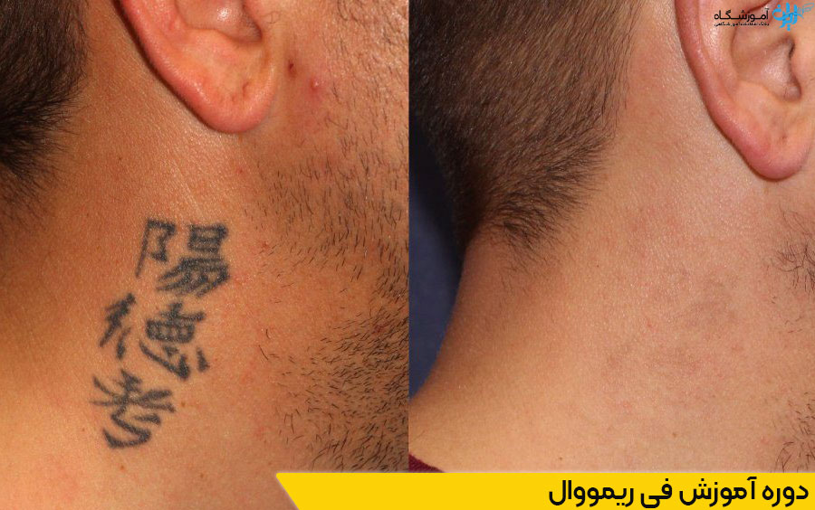 دوره آموزش فی ریمووال