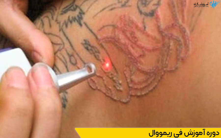 دوره فی ریمووال