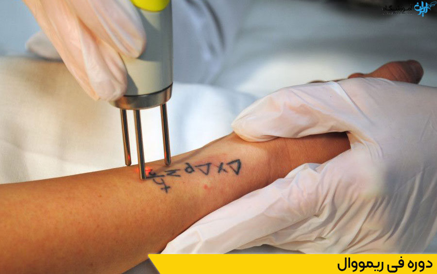 دوره فی ریمووال