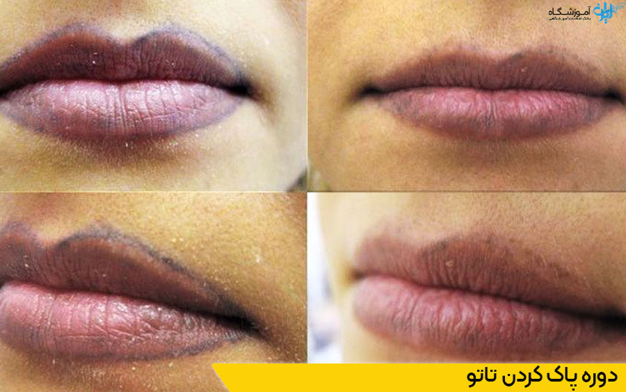 دوره پاک کردن تاتو