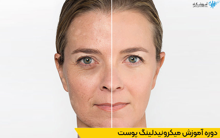 دوره آموزش میکرونیدلینگ