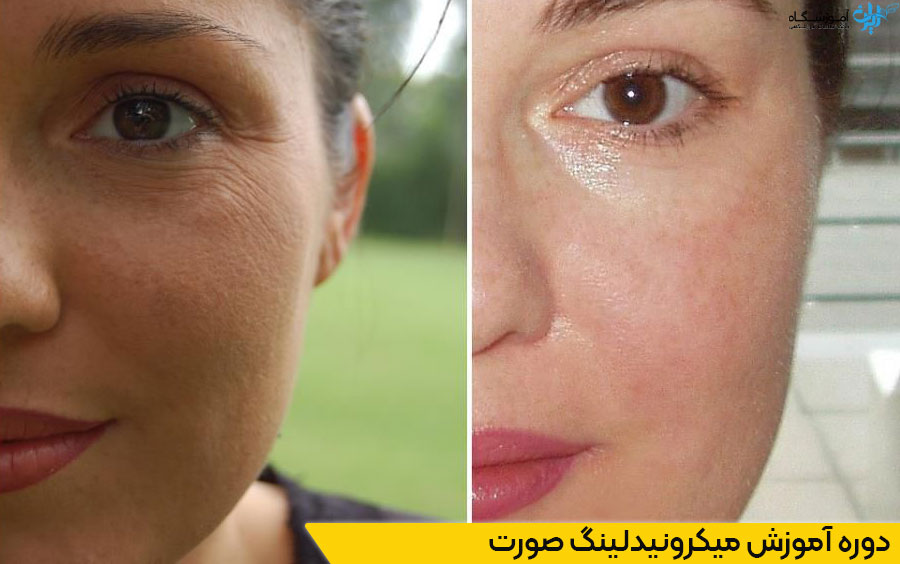 آموزش میکرونیدلینگ