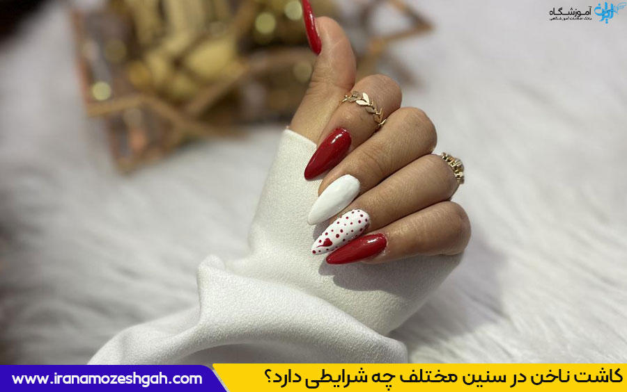 سن کاشت ناخن