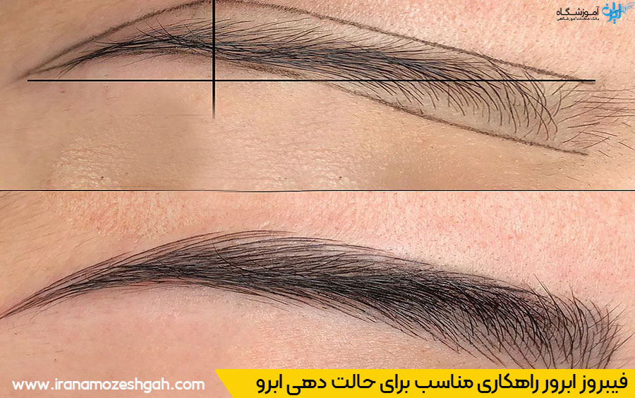 فیبروز ابرو چیست