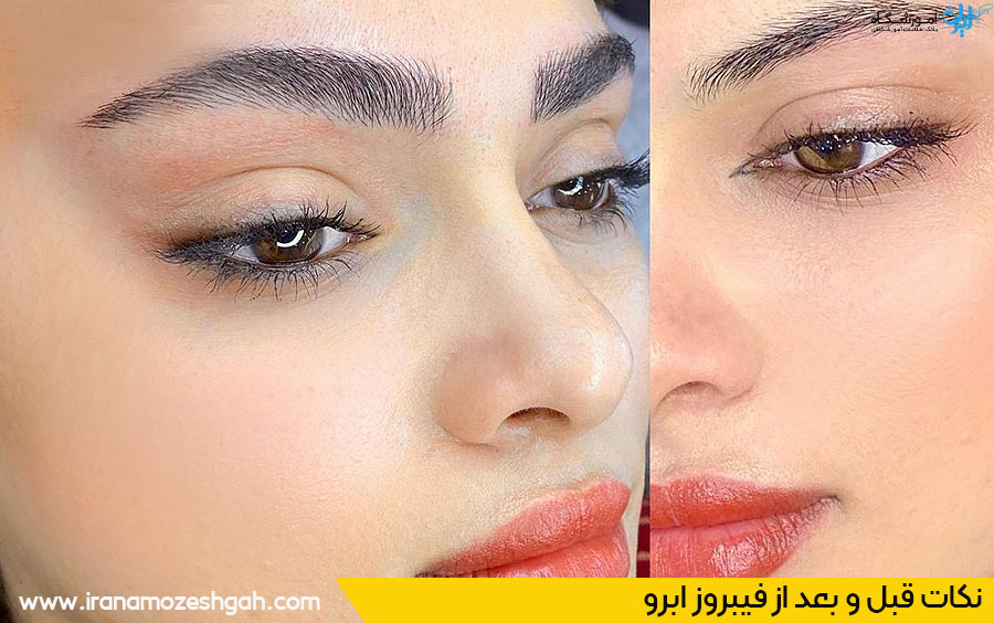 نکات قبل و بعد از فیبروز ابرو