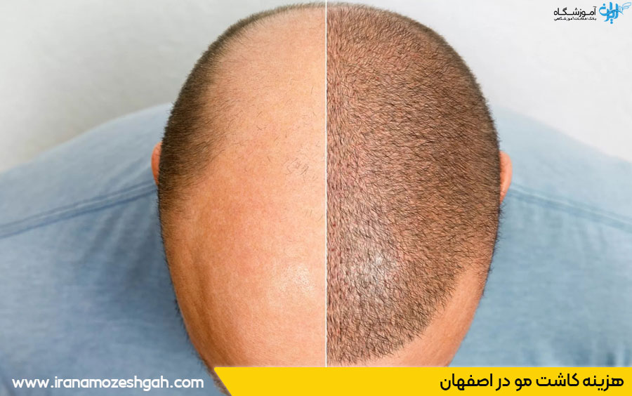 قیمت کاشت مو اصفهان