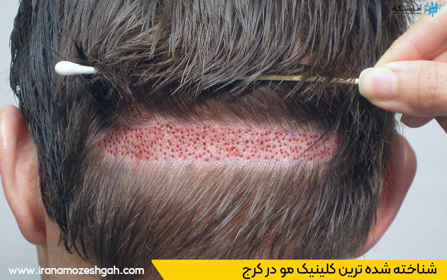 معروف ترین کلینیک مو کرج