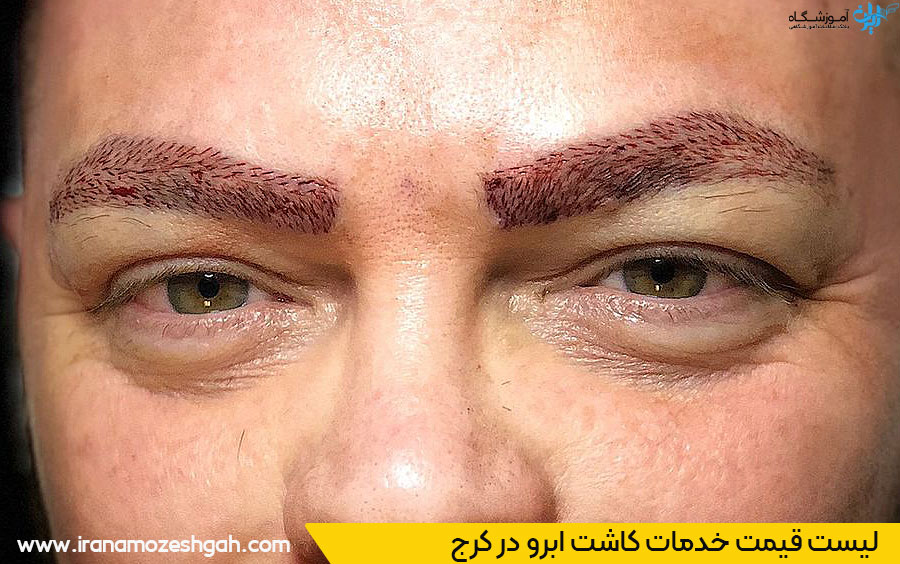 هزینه کاشت ابرو کرج