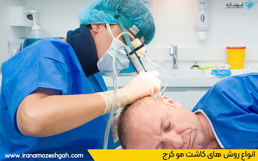 روش های کاشت مو کرج