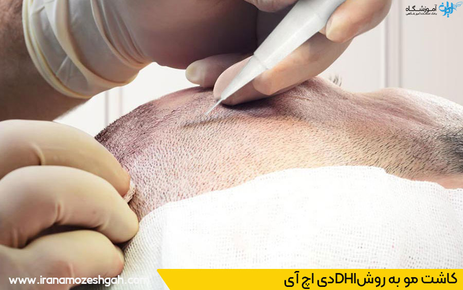کاشت مو به روش دی اچ آی