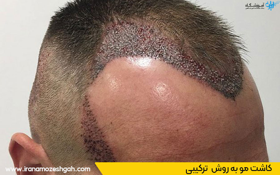 کاشت مو ترکیبی کرج