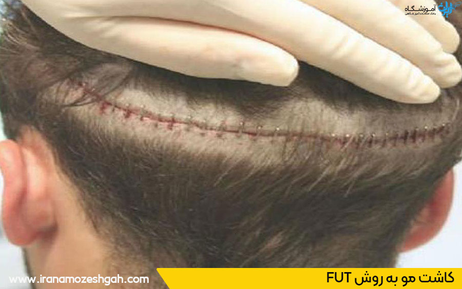 کاشت مو به روش فوت FUT