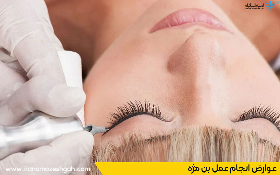 عوارض بن مژه