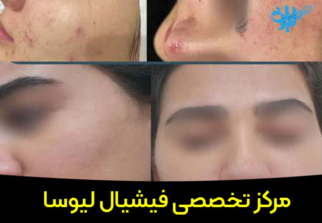 خدمات فیشیال صورت ساقی بیوتی لیوسا