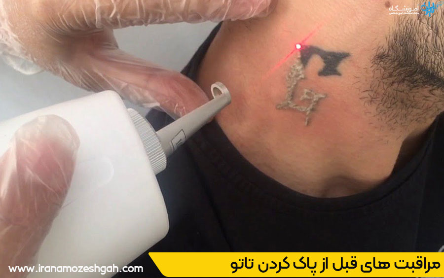 مراقبت های قبل از پاک کردن تاتو