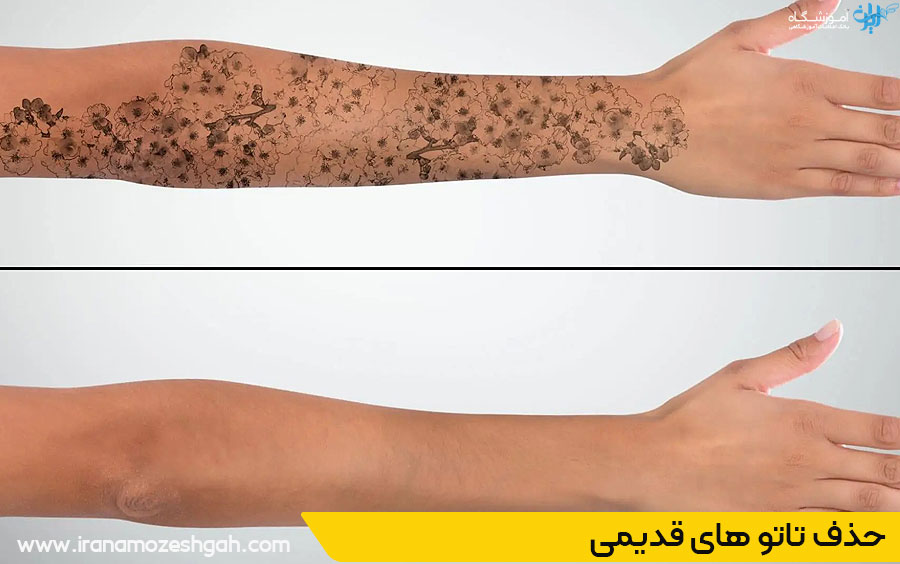 حذف تاتو های قدیمی در فردیس