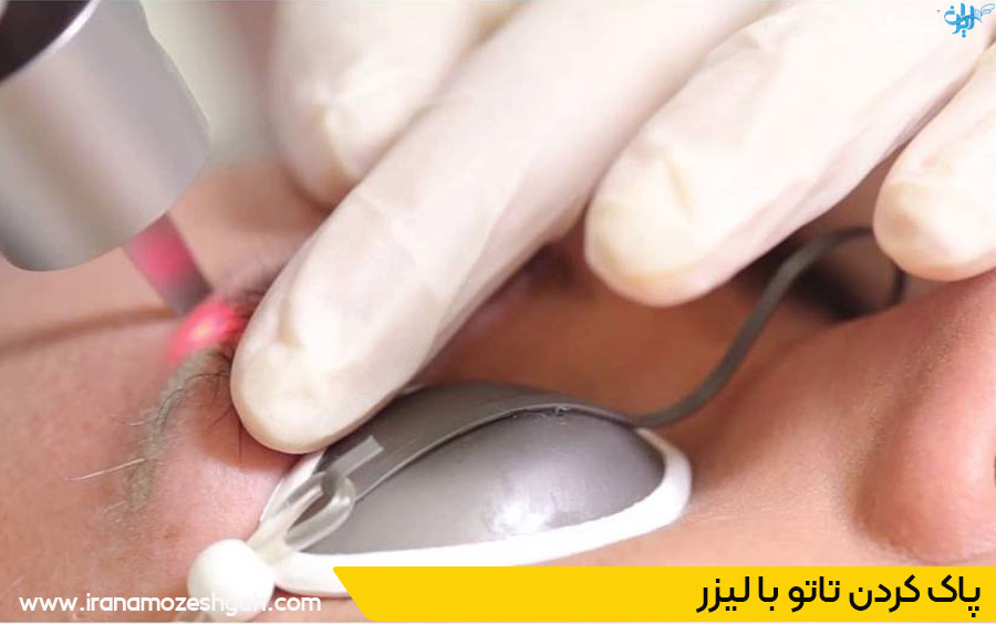 ریموو تاتو ابرو در فردیس