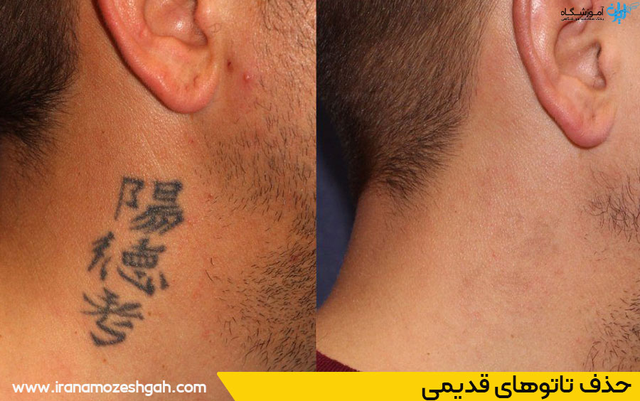 بهترین مراکز آموزش ریموو تاتو در گلشهر