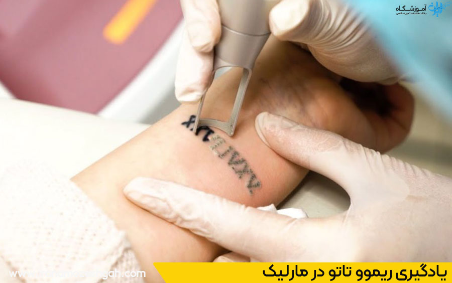 ریموو تاتو در مارلیک