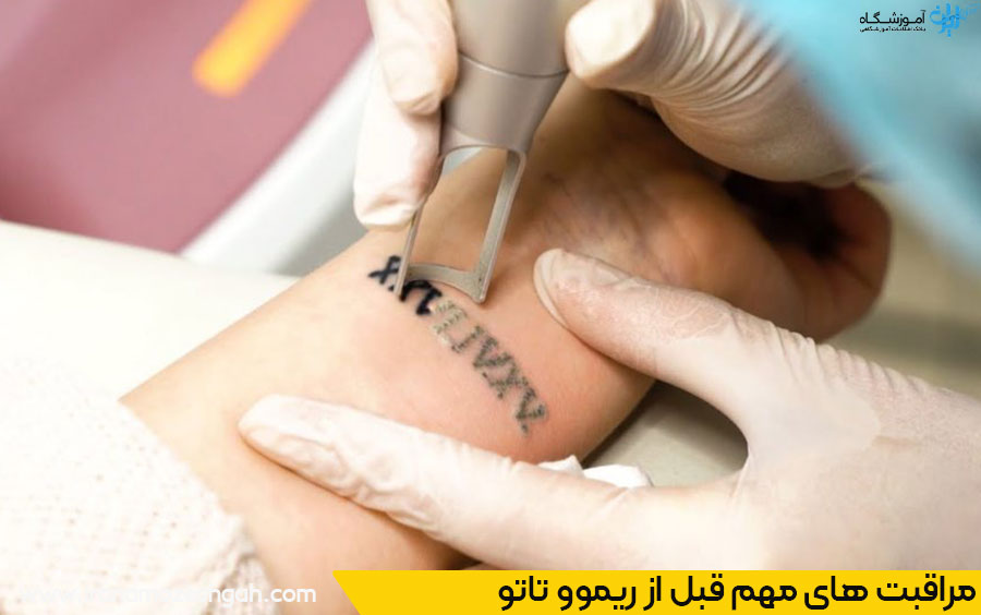 نکات مهم قبل از ریموو تاتو