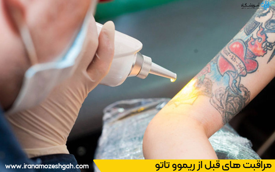 نکات مهم قبل از ریموو تاتو