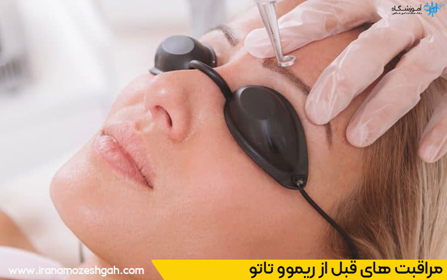 نکات مهم قبل از ریموو تاتو