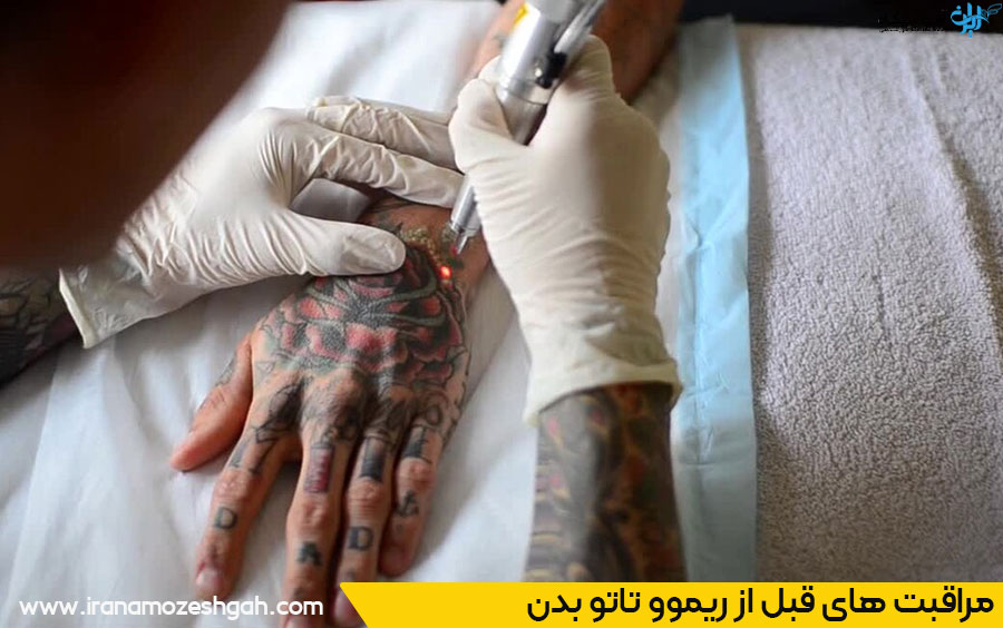 نکات مهم قبل از ریموو تاتو