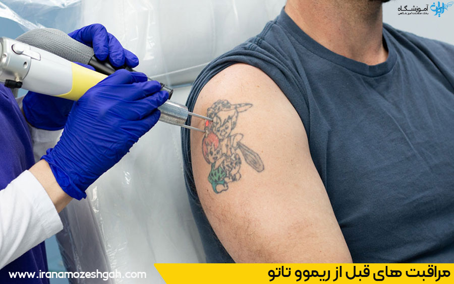 نکات مهم قبل از ریموو تاتو