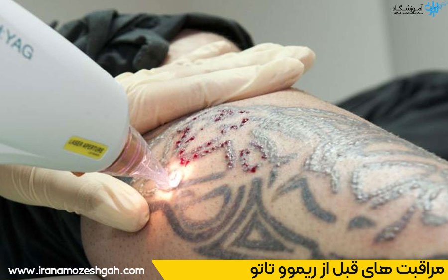 نکات مهم قبل از ریموو تاتو