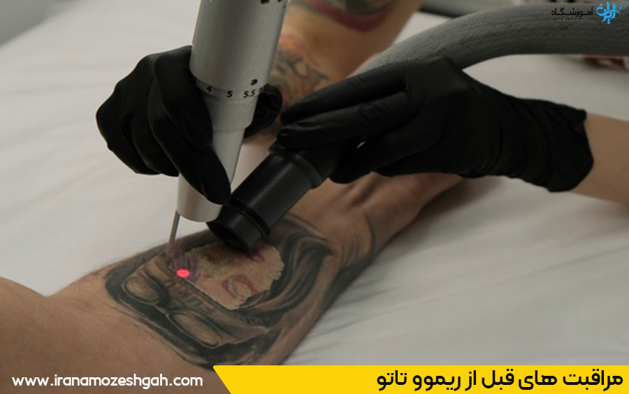 نکات مهم قبل از ریموو تاتو