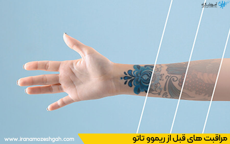 نکات مهم قبل از ریموو تاتو