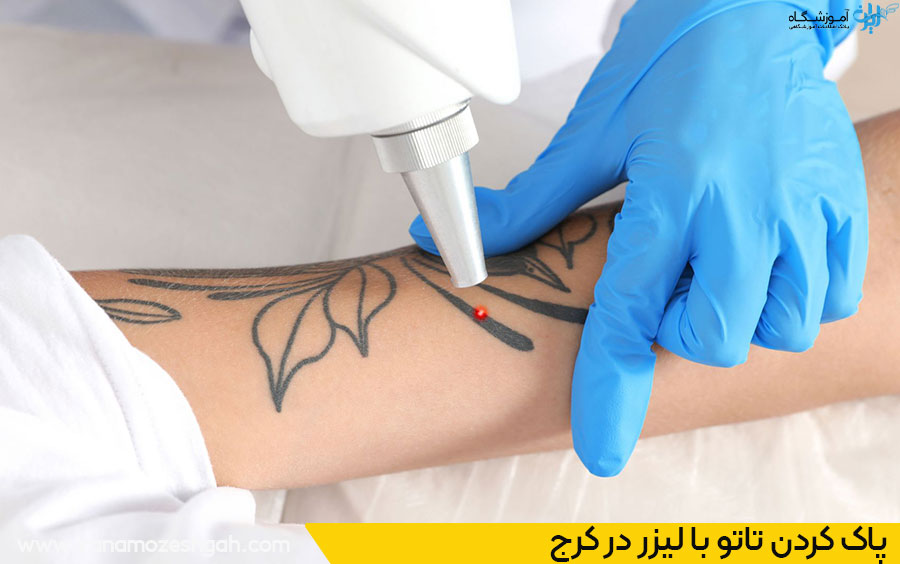 ریموو تاتو با لیزر