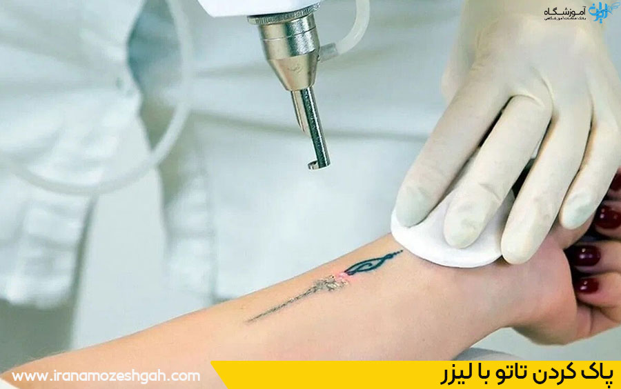 ریموو تاتو با لیزر