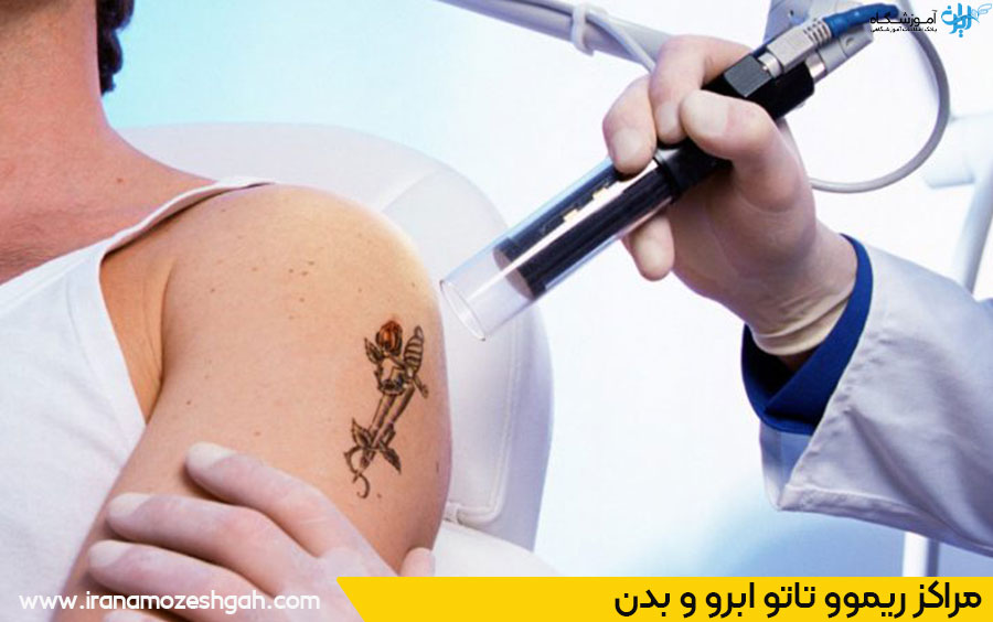 ریموو تاتو با لیزر