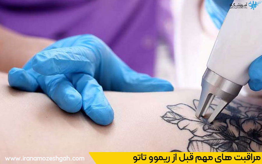 ریموو تاتو با لیزر