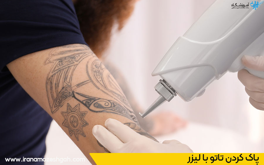 ریموو تاتو با لیزر
