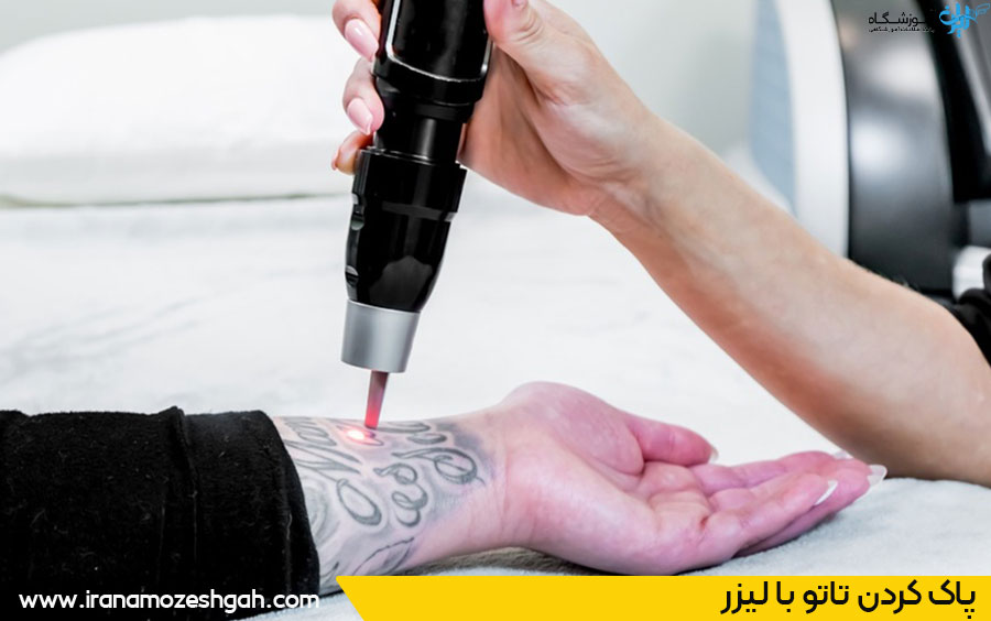 ریموو تاتو با لیزر