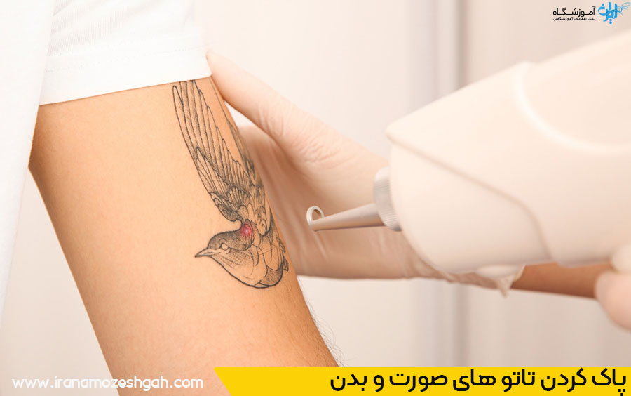 ریموو تاتو با لیزر