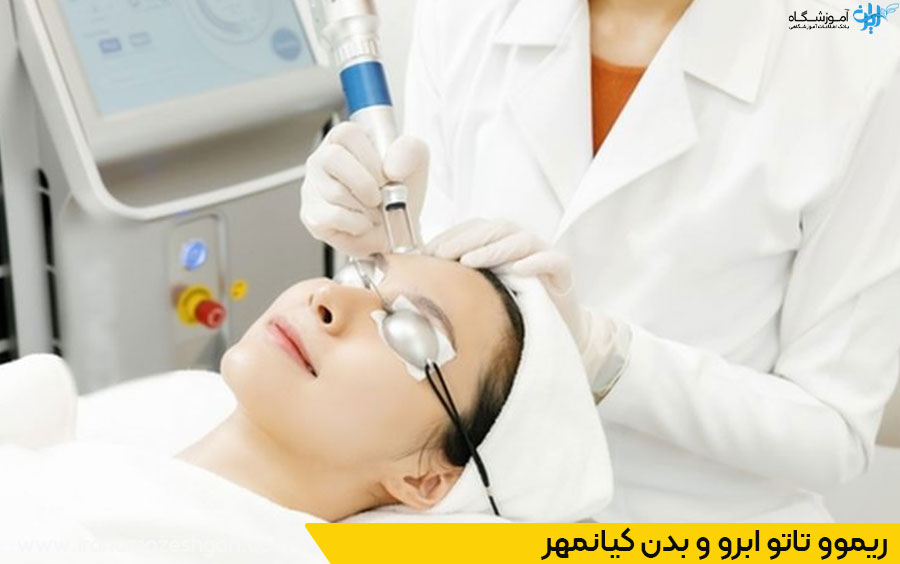 ریموو تاتو با لیزر