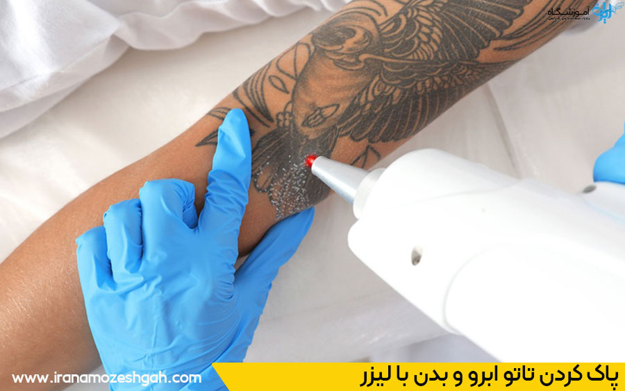 ریموو تاتو با لیزر