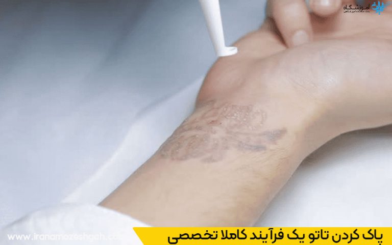 مرکز ریموو تاتو در قم