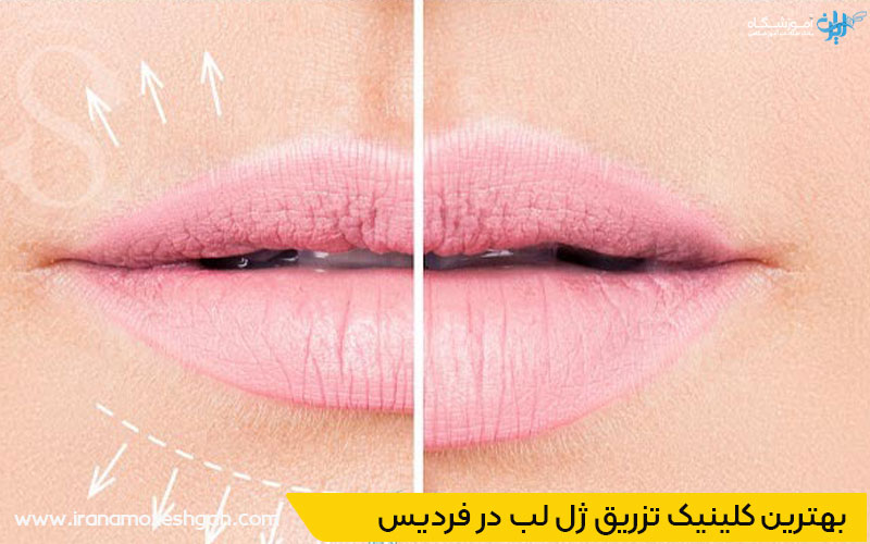 مرکز فیلر لب خوب در فردیس