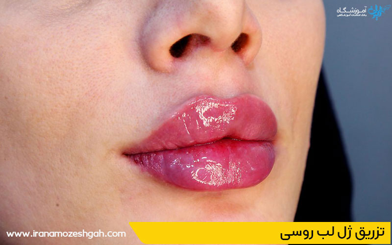 تزریق ژل لب روسی فردیس