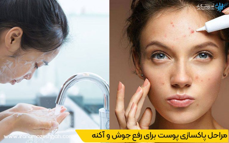 مراحل اساسی پاکسازی پوست برای رفع جوش و آکنه